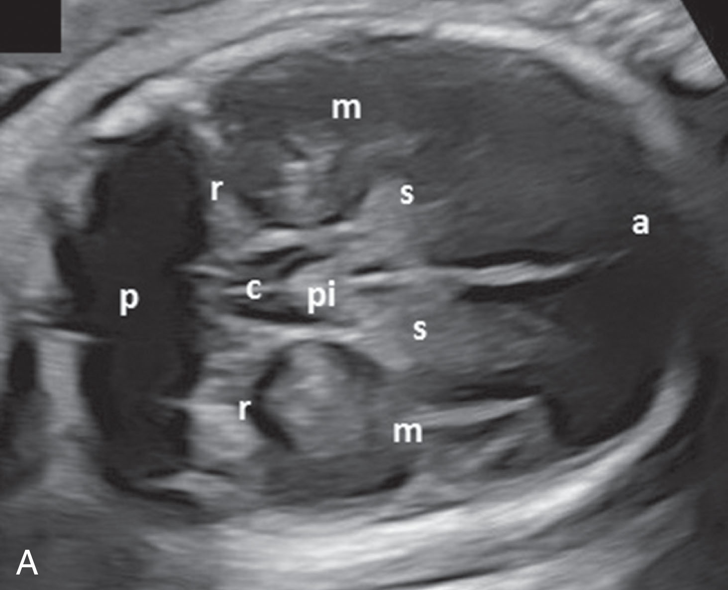 Fig. 51.14, (A) Anatomic depiction at the cerebellar level showing the cerebral peduncles (p) positioned anteriorly to the cerebellum (c). The dural folds that connect the bottom of the falx cerebelli are seen within the cisterna magna (arrow) . (B) In the same fetus, at a level slightly below the cerebellar level, the anterior (a), middle (m), and posterior fossae are shown. Note the sphenoid bones (s) and petrous ridges (r). c , Suprasellar cistern; pi , piarachnoid tissue in the basilar cistern.