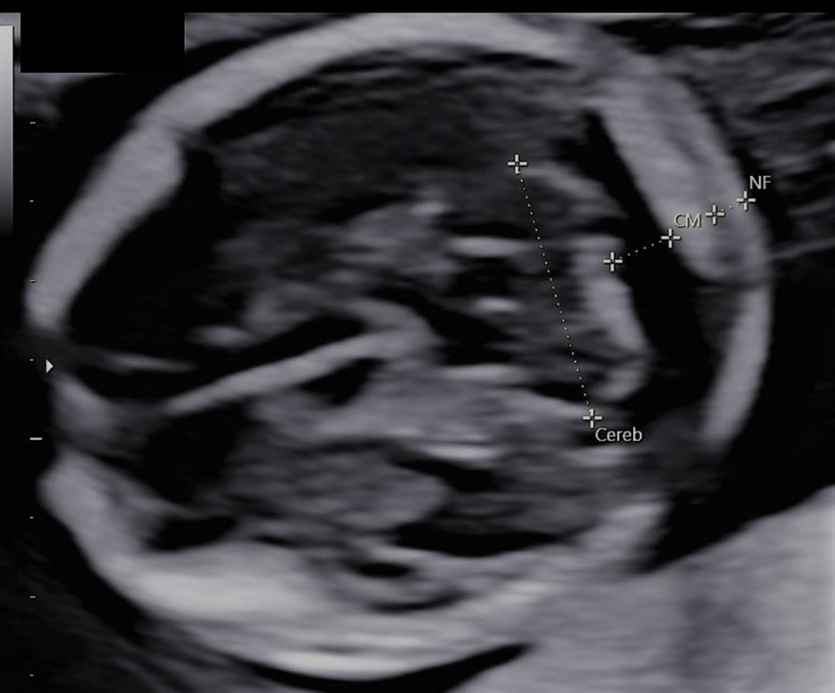 Fig. 51.15, Depiction of a normal cerebellum (Cereb) and cisterna magna (CM) in a normal fetus. At the same level, the skin behind the neck is measured. A normal nuchal skin fold (NF) is shown. This measurement is unreliable after 20 weeks of gestation.