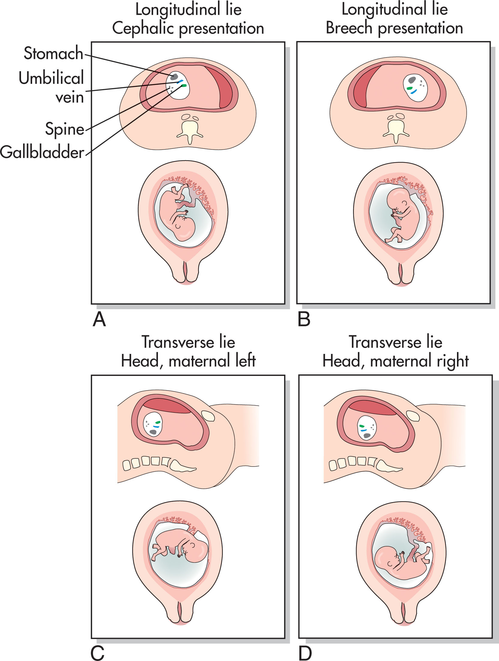 Fig. 51.2, Knowledge of the plane of section across the maternal abdomen (longitudinal or transverse) and the position of the fetal spine and left-side (stomach) and right-side (gallbladder) structures can be used to determine fetal lie and presenting part. (A) This transverse scan of the gravid uterus demonstrates the fetal spine on the maternal right, with the fetus lying with its right side down (stomach anterior, gallbladder posterior). Because these images are viewed looking up from the patient’s feet, the fetus must be in longitudinal lie and cephalic presentation. (B) When the gravid uterus is scanned transversely, and the fetal spine is on the maternal left with the right side down, the fetus is in a longitudinal lie and breech presentation. (C) When a longitudinal plane of section demonstrates the fetal body to be transected transversely, and the fetal spine is nearest the uterine fundus with the fetal left side down, the fetus is in a transverse lie with the fetal head on the maternal left. (D) When a longitudinal plane of section demonstrates the fetal body to be transected transversely, and the fetal spine is nearest the lower uterine segment with the fetal left side down, the fetus is in a transverse lie with the fetal head on the maternal right. Although real-time scanning of the gravid uterus quickly allows the observer to determine fetal lie and presenting part, this maneuver of identifying specific right- and left-side structures within the fetal body force one to determine fetal position accurately and to identify normal and pathologic fetal anatomy.