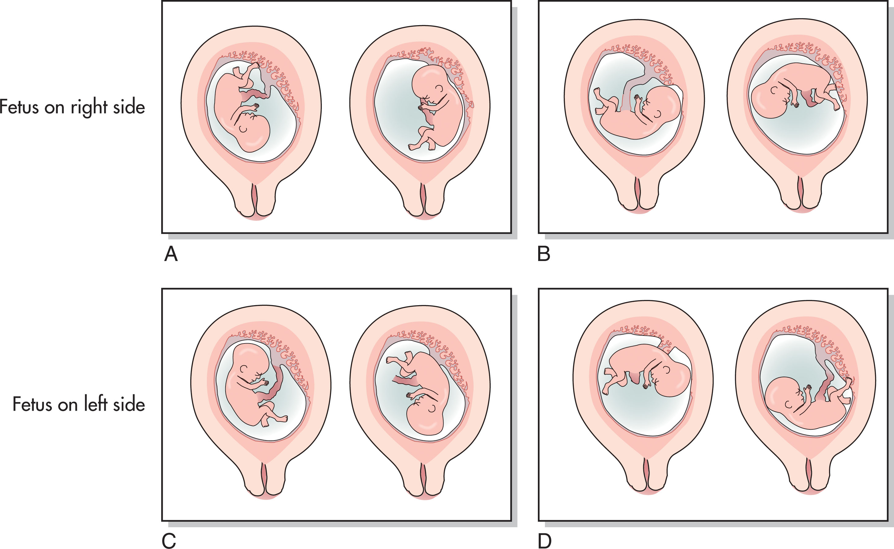 Fig. 51.3, Fetal positions and the method used to differentiate the left side from the right side.