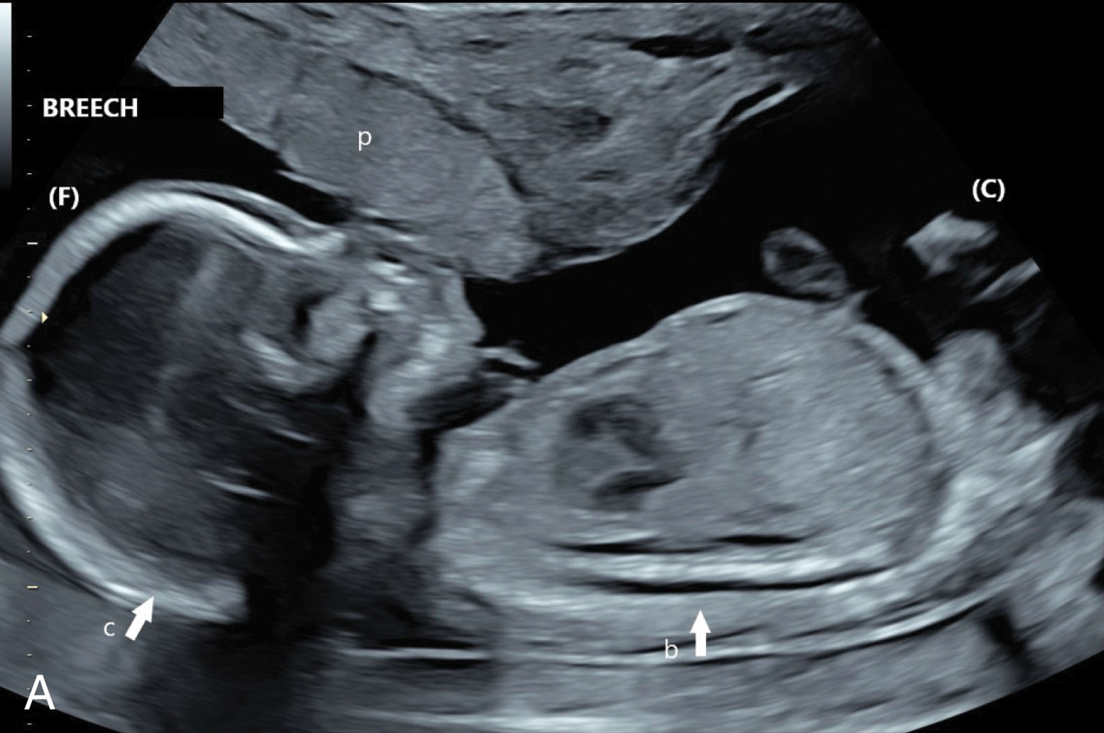 Fig. 51.4, (A) A breech presentation. The body (b) is closest in proximity to the direction of the cervix (C), and the cranium (c) is directed toward the uterine fundus (F). (B) A vertex presentation. The cranium (c) is closest in proximity to the direction of the cervix (C), and the body (b) is directed toward the uterine fundus (F). p , Placenta.