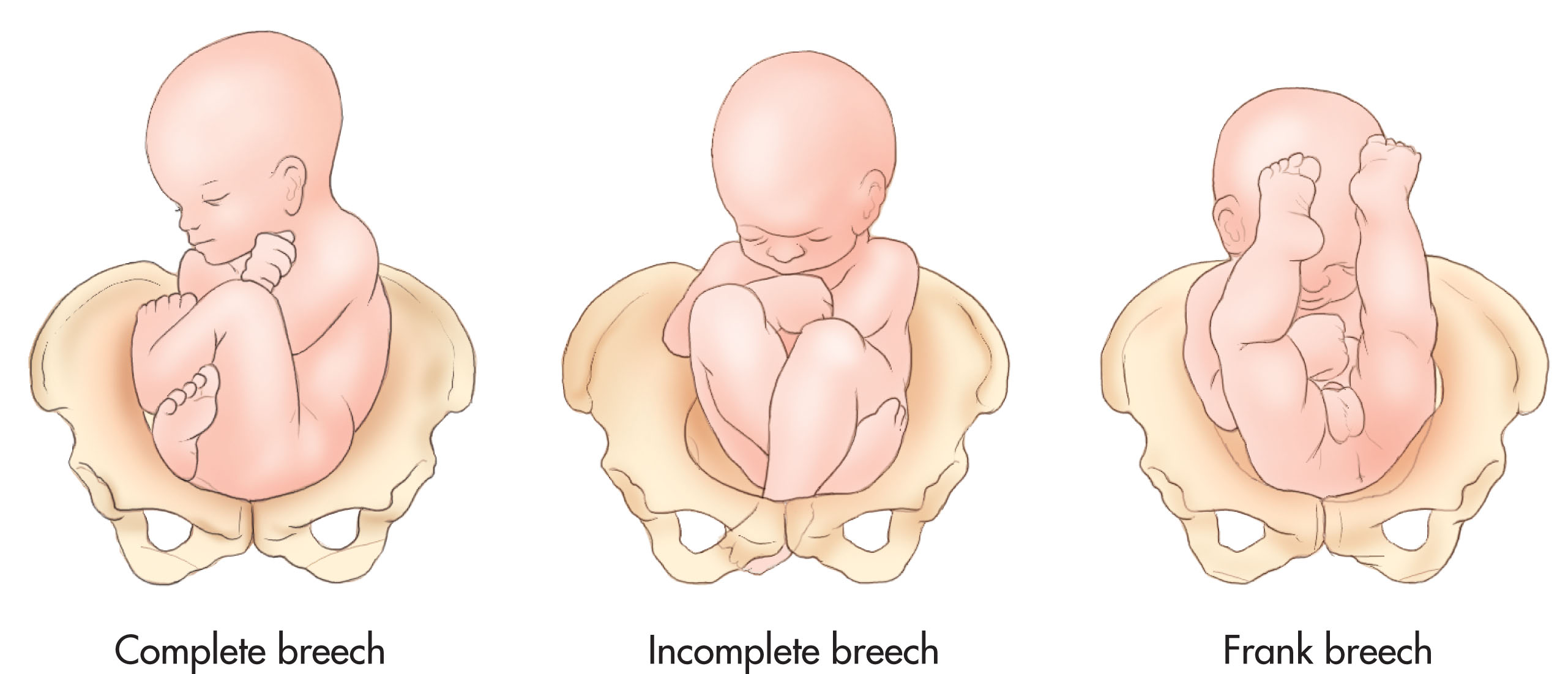 Fig. 51.5, Three possible breech presentations.