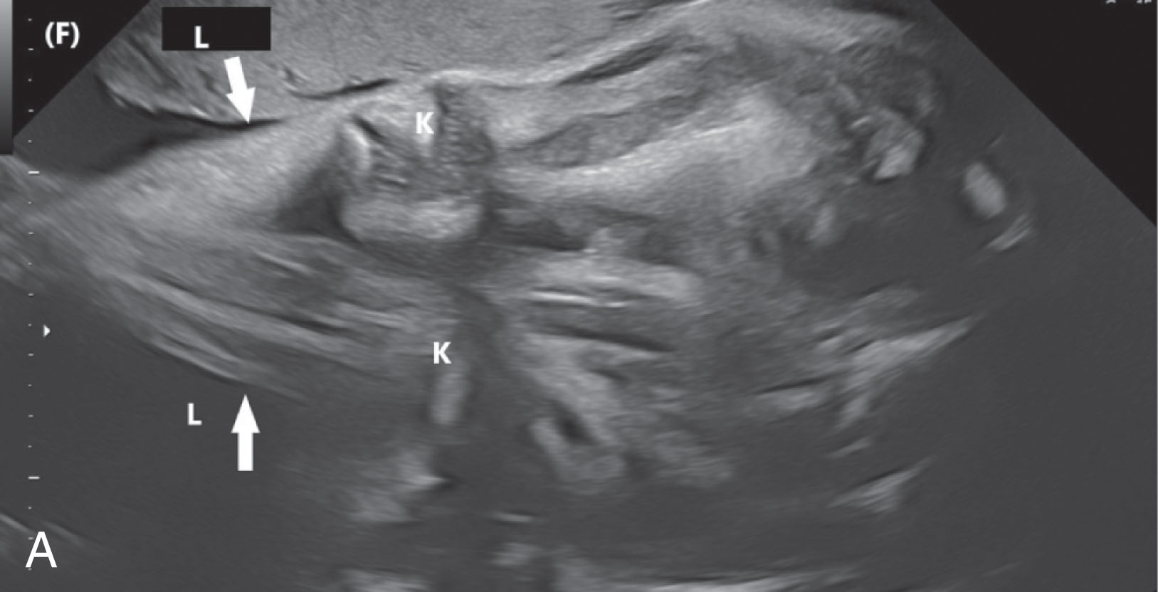 Fig. 51.6, (A) A fetus in a frank breech presentation with both legs extended upward toward the uterine fundus (F). (B) Complete breech presentation with one leg flexed at the hips, with the lower leg (L) and foot positioned under the hips (H). The other leg was in a similar position. A , Abdomen; F , fundus; K , knee; L , lower leg.