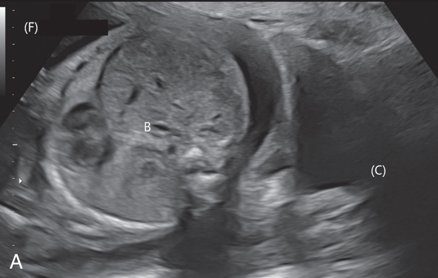 Fig. 51.7, (A) A sagittal scan at the level of the lower uterine segment reveals the fetal body in a transverse position rather than a sagittal or coronal orientation (compare with Fig. 51.4 ). (B) In the same fetus, by rotating the transducer 90 degrees, the abdomen may be connected to the head to reveal the transverse lie with the head oriented to the maternal right side (RT) and the abdomen (A) to the maternal left side (LT). B , Body; C , toward cervix; F , fundus.