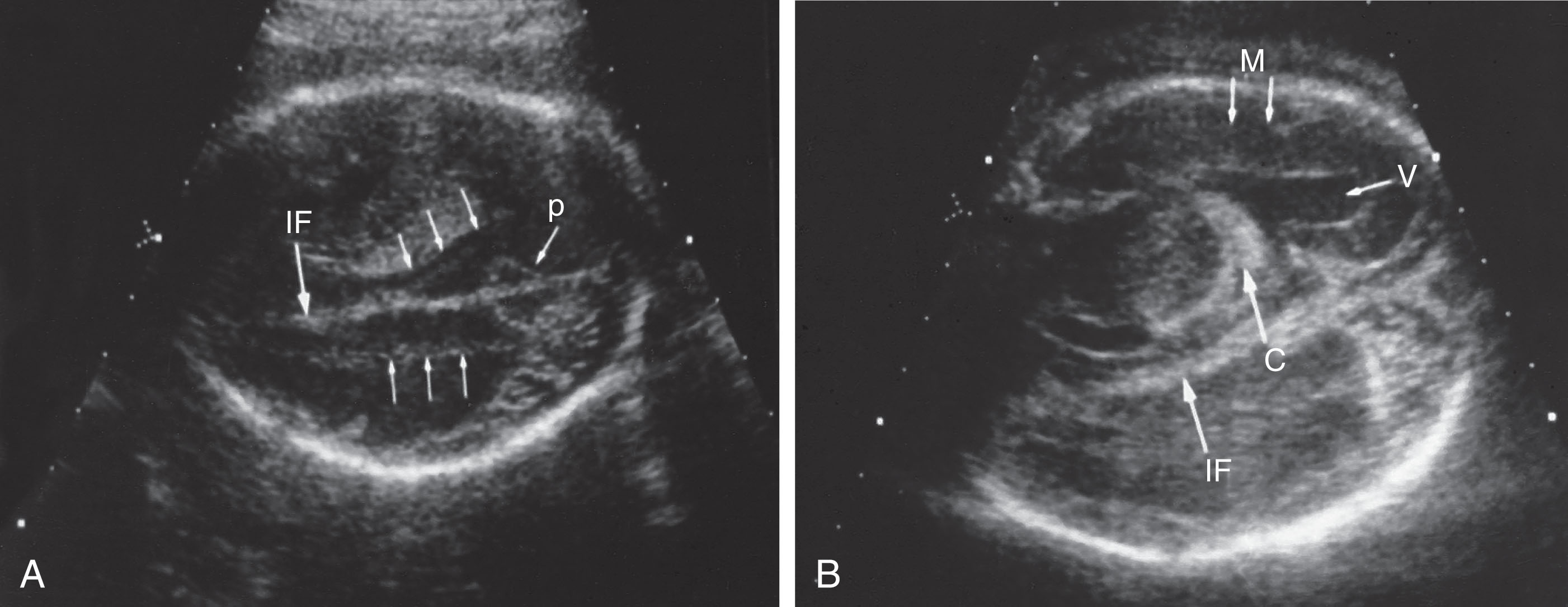 Fig. 51.9, (A) Transverse cross section revealing white-matter tracts (arrows) coursing parallel to the interhemispheric fissure (IF) at 26 weeks of gestation. (B) The choroid plexus (C) is located in the proximal or near hemisphere within the ventricular cavity (V). Note the homogeneous appearance of the brain tissue. M , Mantle; P , peduncles.