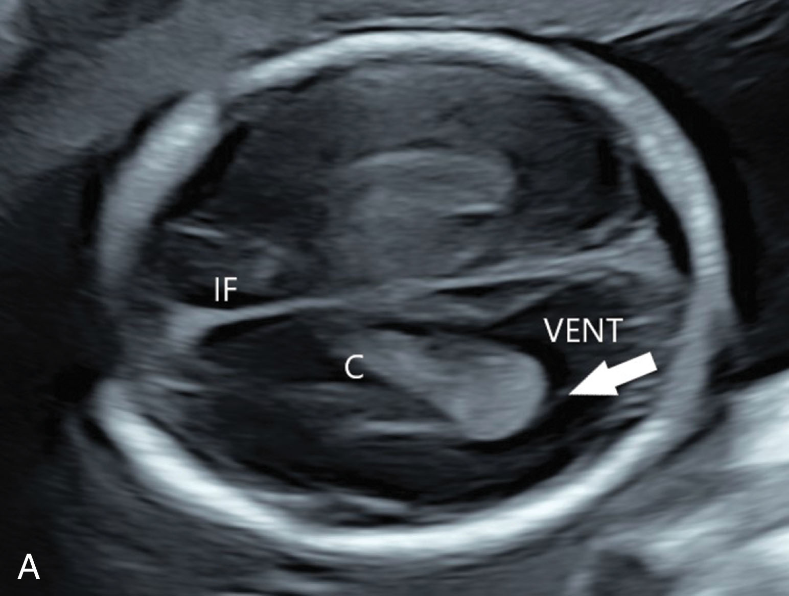 Fig. 51.10, (A) Transverse view demonstrating ventricular atrial diameter representing a normal-size ventricle (Vent). (B) Measurements of the atria of the lateral ventricle diameters that correspond to normal-size ventricles. C , Choroid plexus; IF , interhemispheric fissure.