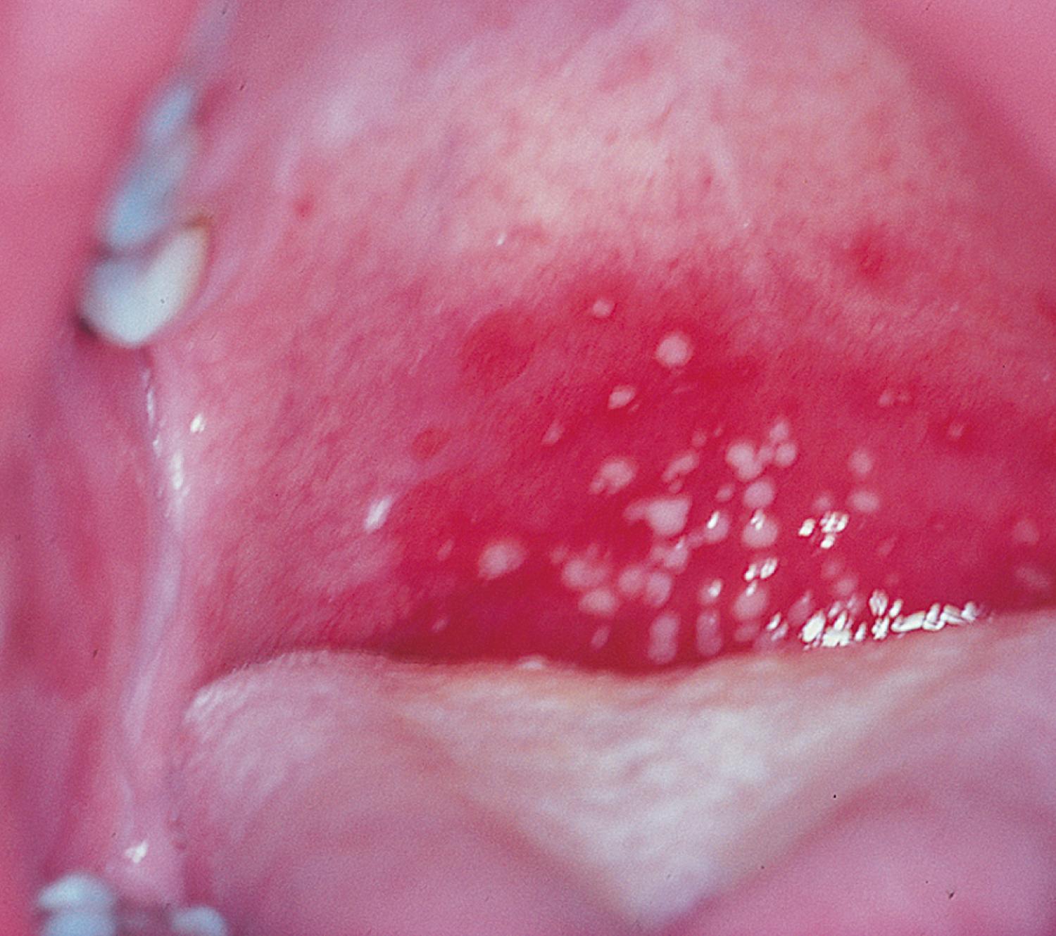 Fig. 2.1, Herpangina with shallow ulcers in the posterior oropharynx.