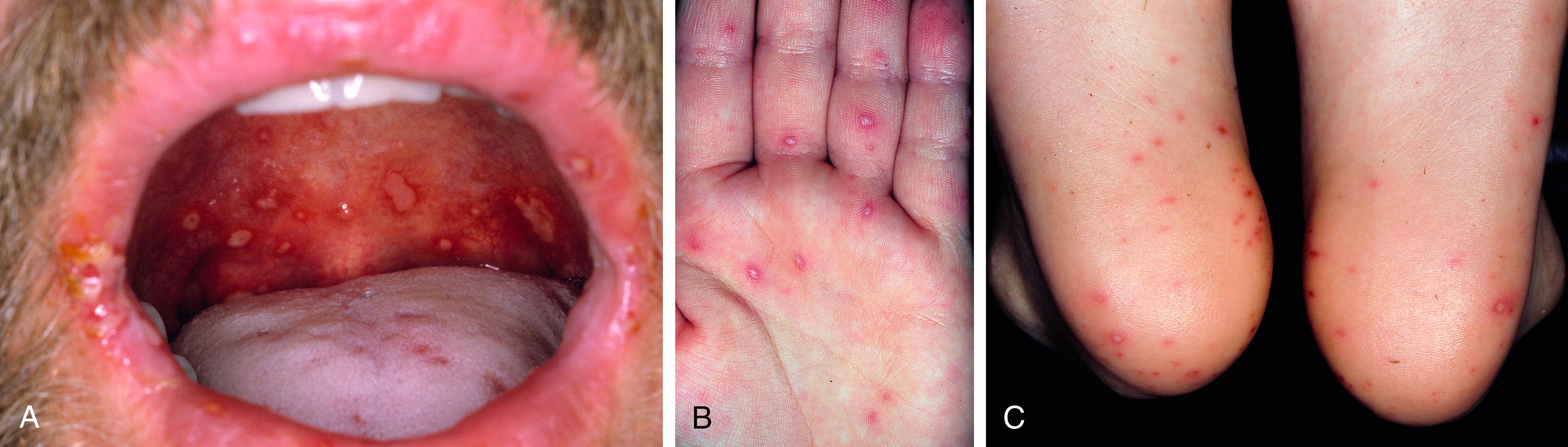 Fig. 2.2, A, Hand-foot-mouth disease. Aphthae-like erosions may appear anywhere in the oral cavity. B, Hand-foot-mouth disease. Cloudy vesicles with a red halo are highly characteristic of this disease. C, Hand-foot-mouth disease. The pale, white, oval vesicles with a red areola are a distinguishing feature of this disease.