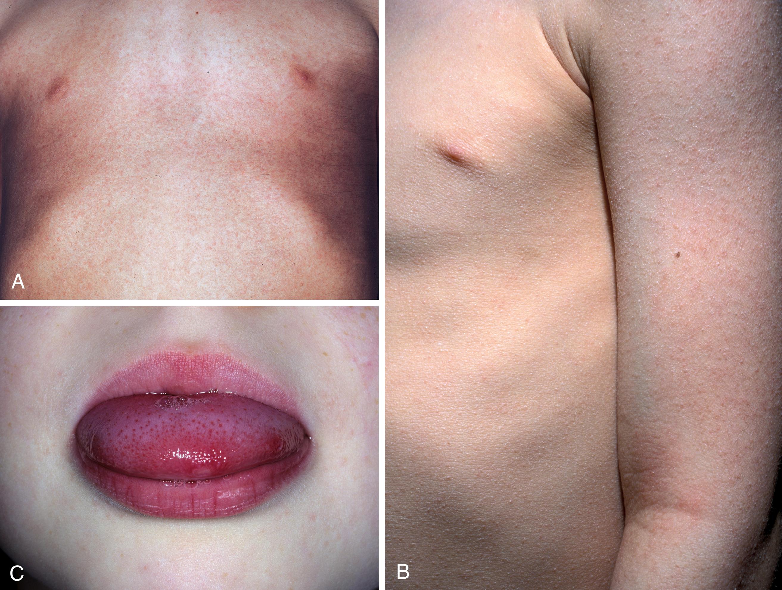 Fig. 2.5, A, Scarlet fever. Early eruptive stage on the trunk showing numerous pinpoint red papules. B, Fully evolved eruption. Numerous papules giving a sandpaper-like texture to the skin. C, Portions of the white coat remain in the center, but the remainder of the tongue is red with engorged papillae (“strawberry tongue”).