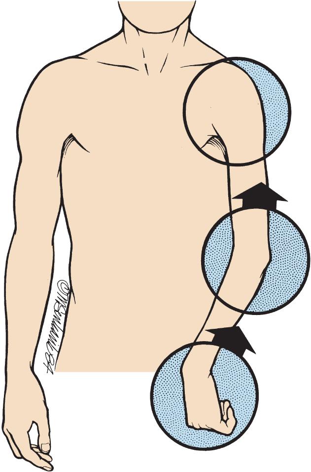 FIG 118.1, Typical posturing of a spastic upper extremity in a patient with right-sided hemiplegia due to cerebral palsy. The elbow is flexed, with forearm pronation, wrist flexion and ulnar deviation, and thumb-in-palm deformity.