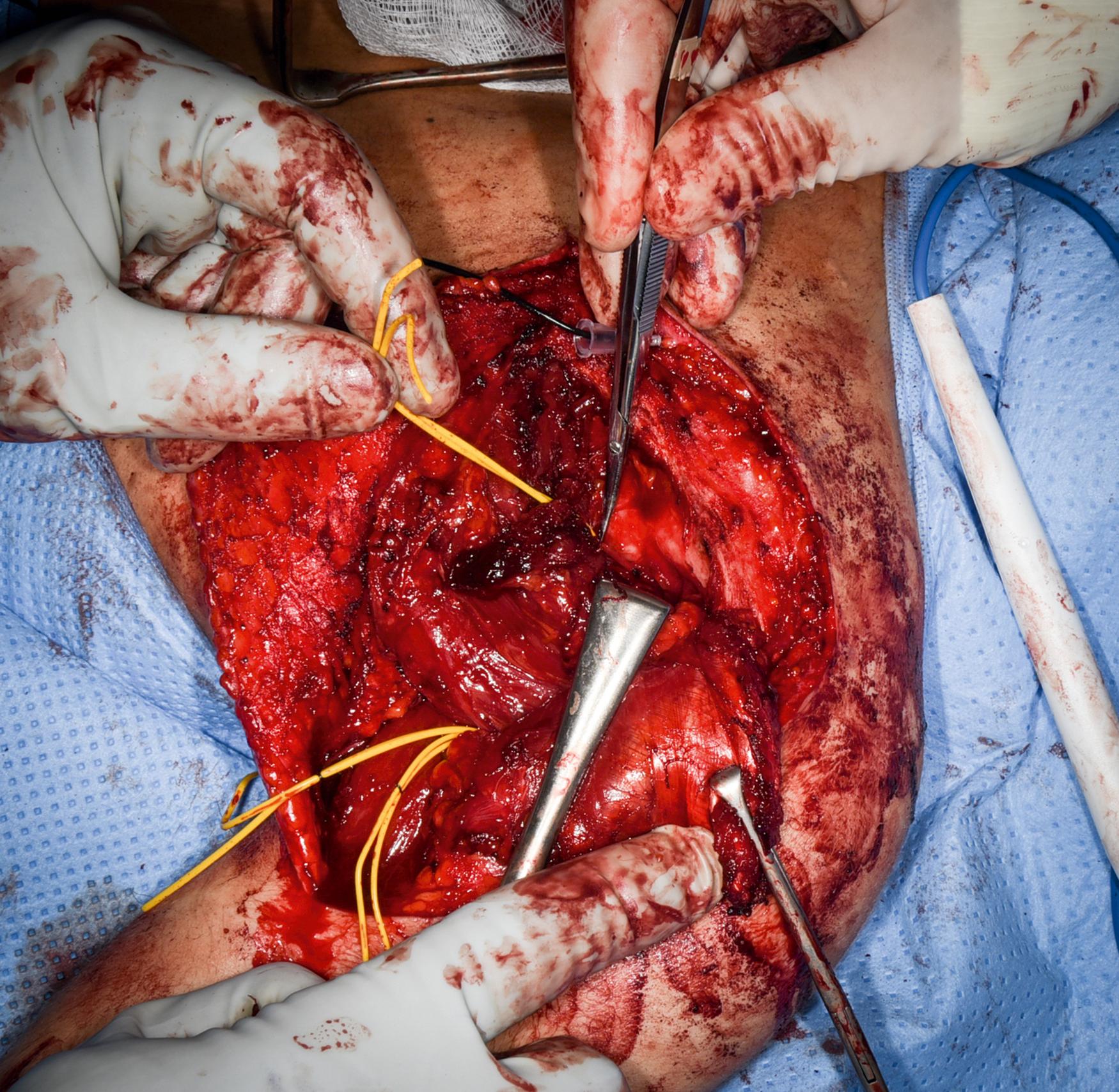 eFig. 32.8, Suprascapular nerve to infraspinatus muscle cut.