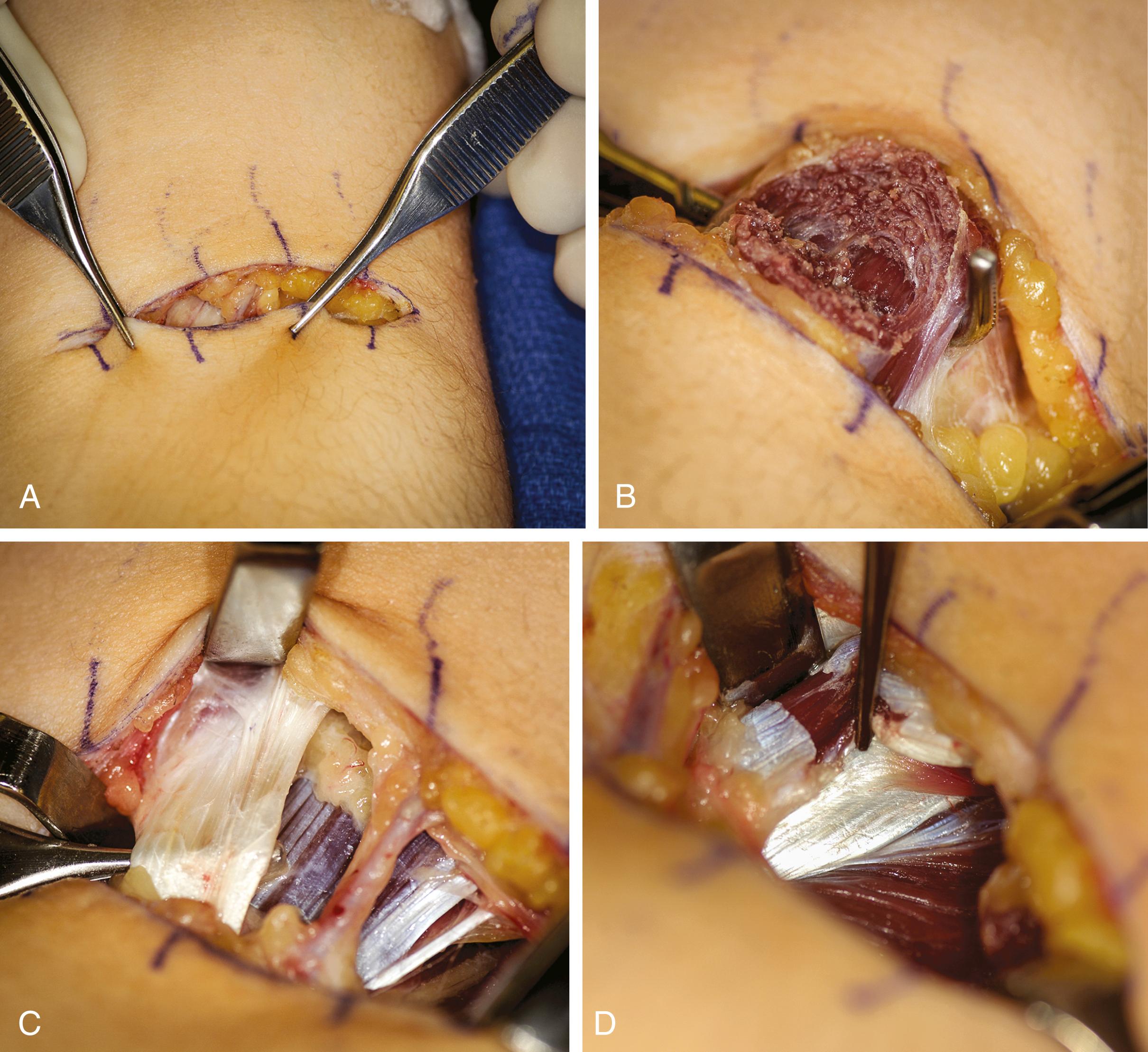 Fig. 32.4, A 16-year-old male with left-sided spastic hemiparesis and excessive elbow flexion posturing. A, Transverse antecubital incision. B, Brachioradialis muscle is isolated and the muscle cut with an electrocautery. C, Biceps tendon is mobilized. D, The brachialis muscle tendon junction identified and a fractional lengthening performed.