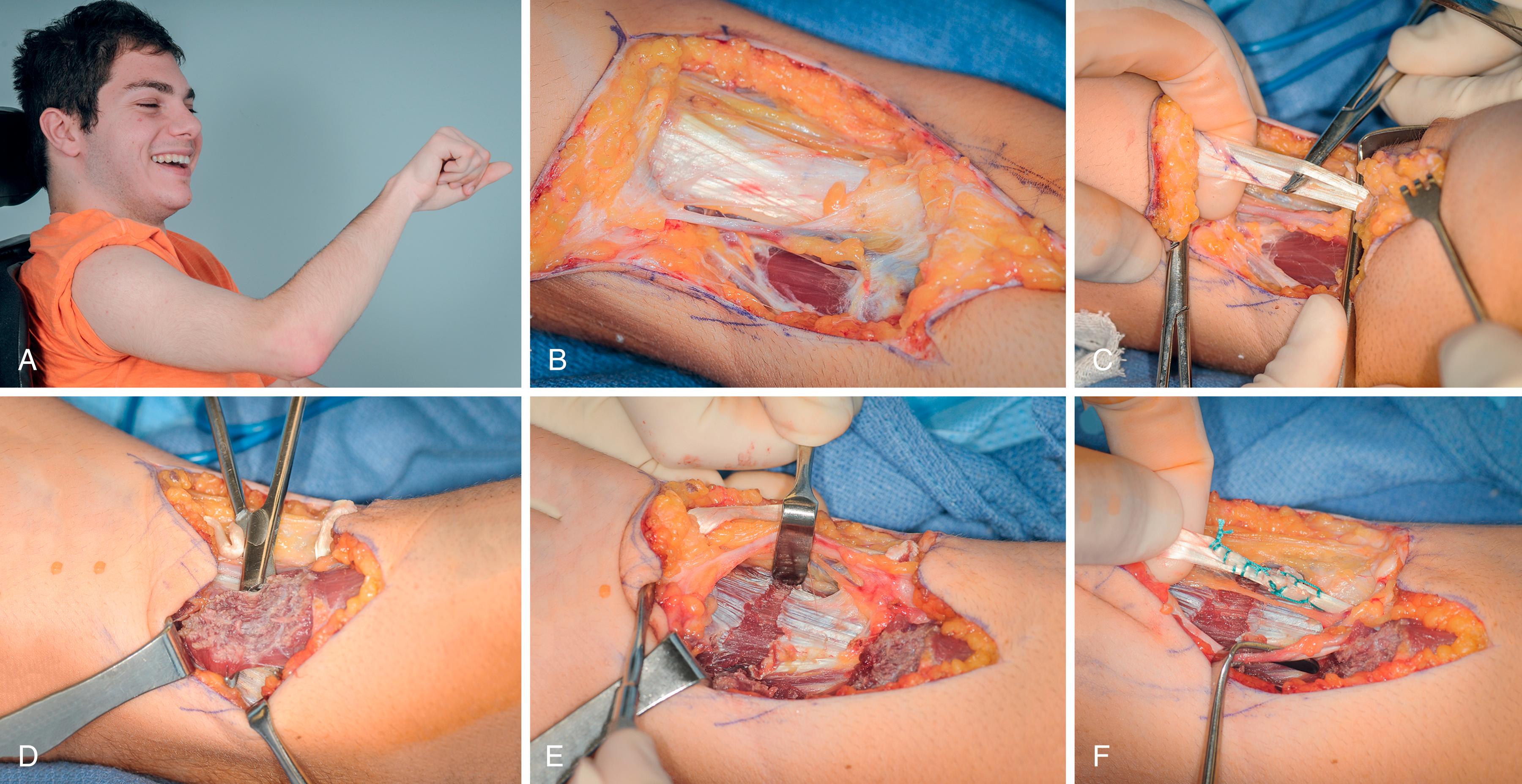 Fig. 32.5, An 18-year-old with spastic quadriplegic cerebral palsy and malpositioned contracted right elbow. A, Clinical picture. B, Z-plasty of the skin across antecubital fossa. C, Z-lengthening of the biceps tendon. D, Brachioradialis myotomy. E, Brachialis fractional lengthening. F, Biceps repaired in elongated configuration.