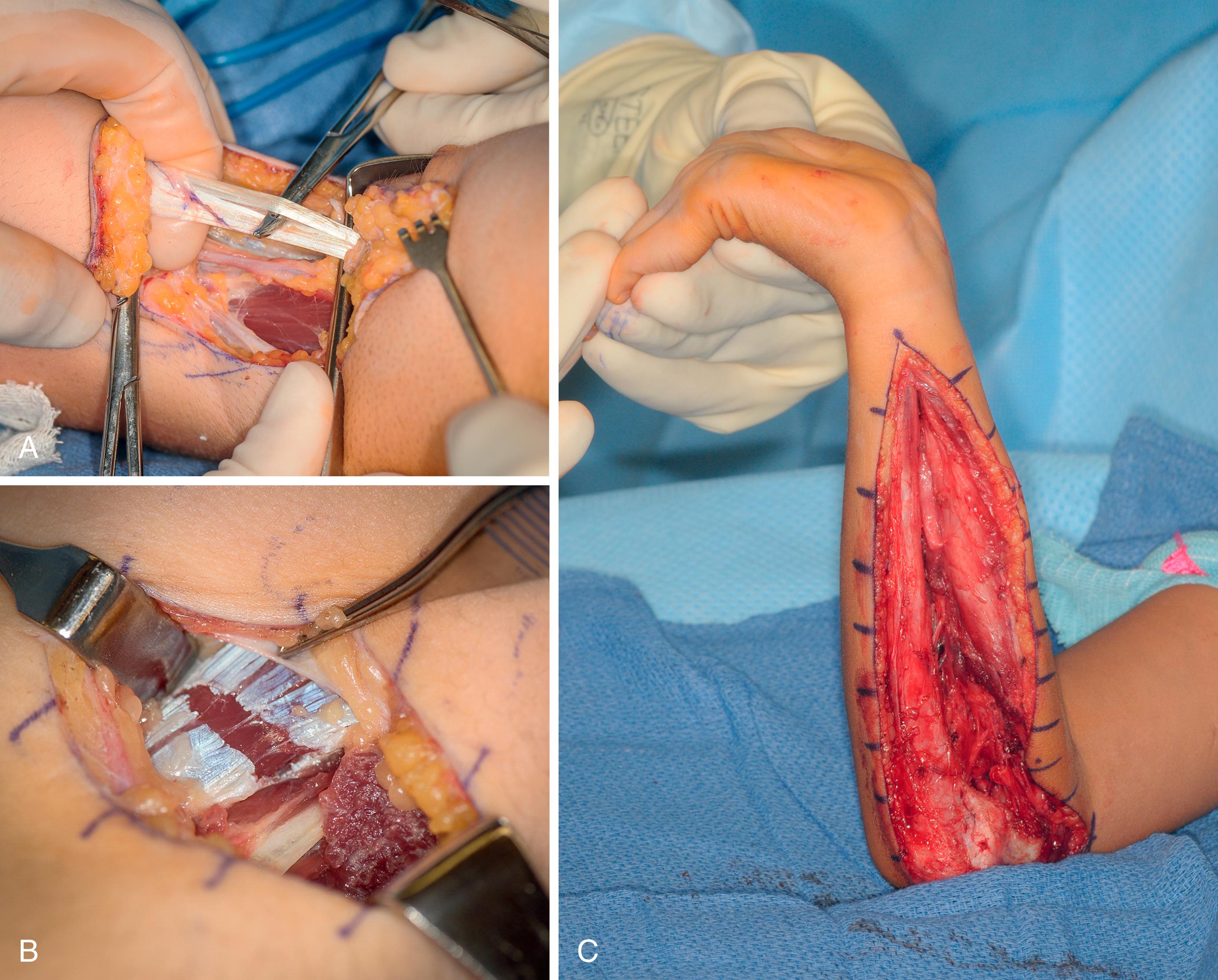 Fig. 32.2, A muscle-tendon unit can be lengthened using one of three methods. A, Z-plasty lengthening of biceps tendon. B, Fractional lengthening of the brachialis muscle-tendon junction. C, Muscle slide of the flexor pronator origin.