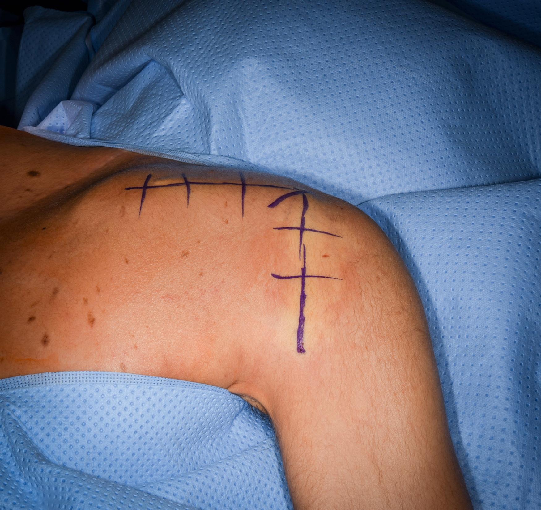 eFig. 32.3, Skin incision.