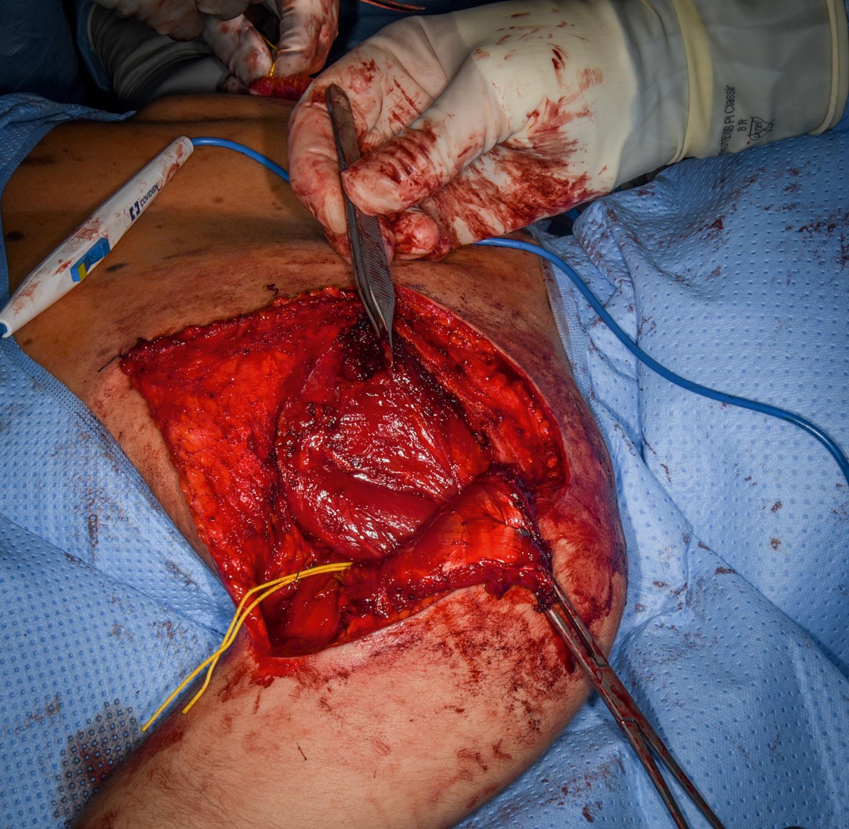 eFig. 32.5, Deltoid elevation and axillary nerve isolated (yellow loop) .