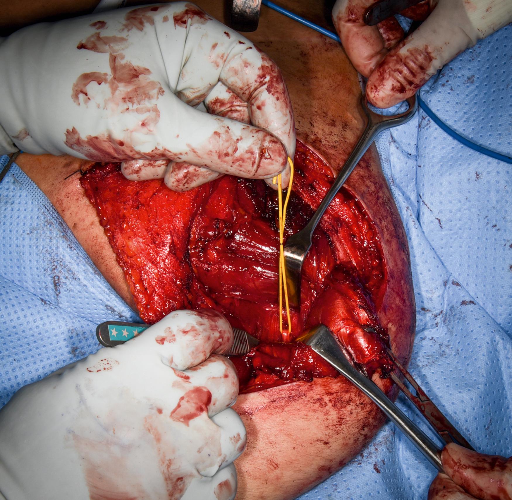 eFig. 32.6, Axillary nerve cut.