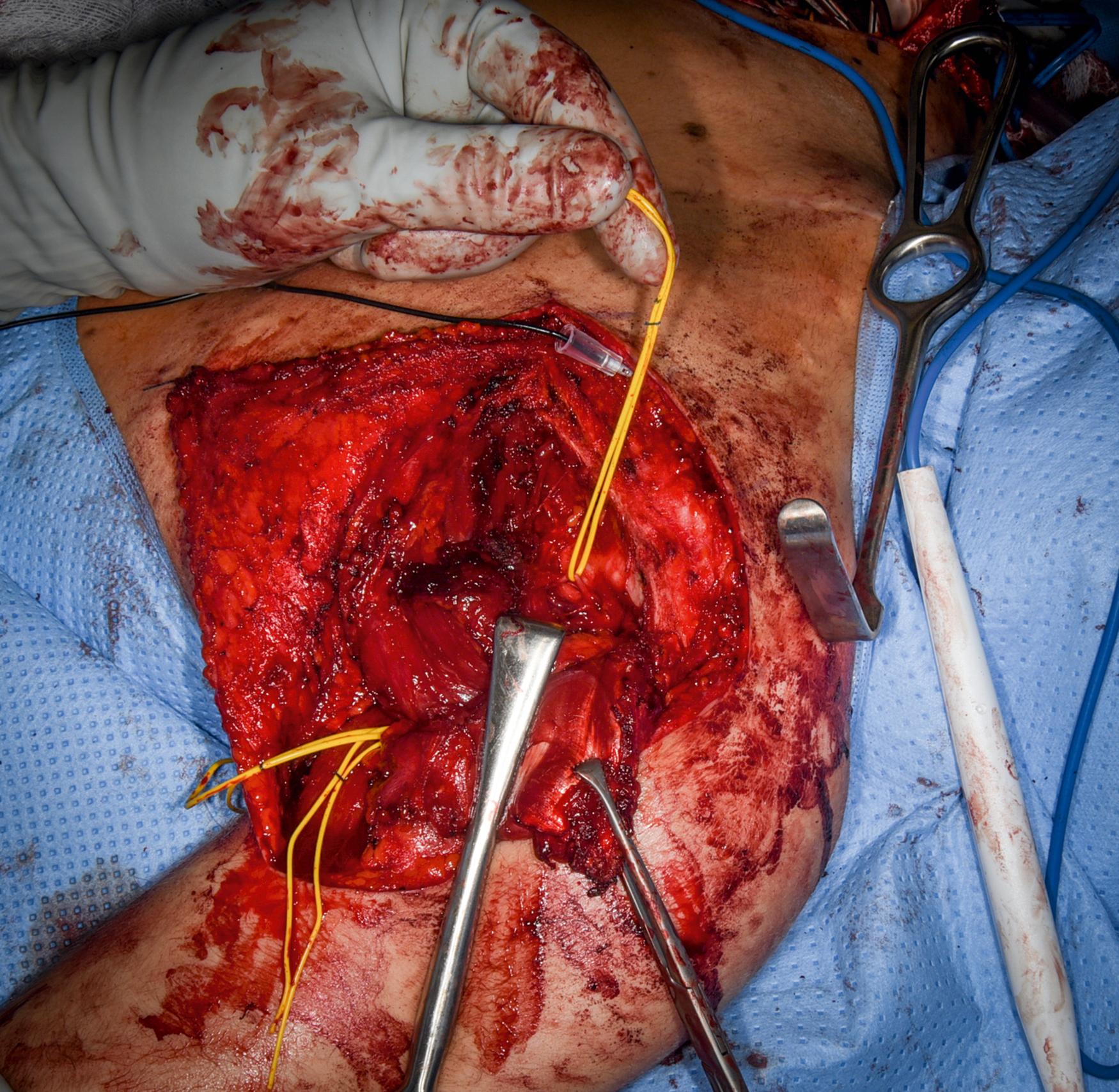 eFig. 32.7, Suprascapular nerve to infraspinatus muscle.