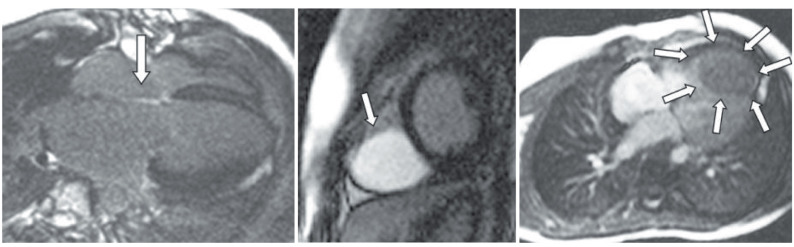 FIG. 12.14, Late gadolinium enhancement (LGE) and perfusion. The left panel is an LGE image of a patient following complete atrioventricular canal repair and demonstrated high signal intensity over the region of the patch repair (arrow). The middle panel is an LGE image of a 1-year-old child with a very large right ventricular fibroma depicting how nicely the tumor lights up (arrow). The right panel is a still frame from a perfusion series of the same patient in the middle image demonstrating a ring of high-intensity signal in the tumor and much lower signal intensity in the middle of the tumor (arrows).