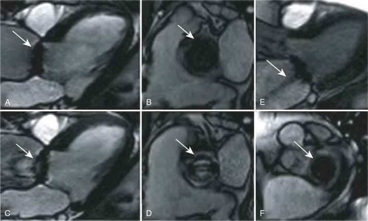 FIG. 10.1, Bileaflet, tilting disc, mechanical aortic valve prosthesis (arrow) during diastole on steady-state free precession (SSFP) imaging (A). Short-axis view of the same prosthesis (arrow) as in A during diastole, clearly demonstrating an artifact (B). Systolic image of the prosthesis (arrow) in A (C). Systolic, short-axis view of the same prosthesis (arrow) as in B, with both leaflets visible in the open position (D). Bileaflet, tilting disc, mechanical mitral valve prosthesis during systole on an SSFP image, demonstrating a regurgitant jet (arrow) (E). Short-axis view of the same prosthesis (arrow) as in E (F).