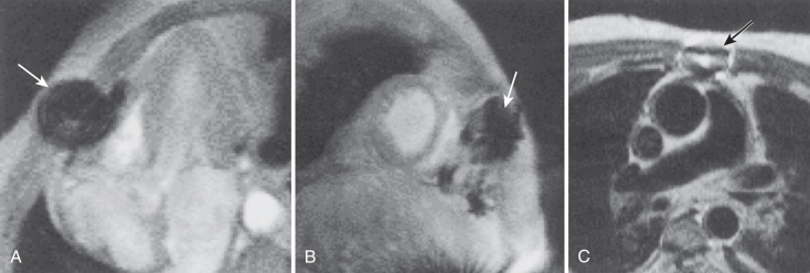 FIG. 10.2, Cardiovascular magnetic resonance image of a patient with sternal wires after bypass grafting. The artifact is clearly seen (arrows) on the horizontal long-axis (A) and short-axis (B) gradient echo cine images, and to a much lesser extent, on the transaxial spin echo image (C).