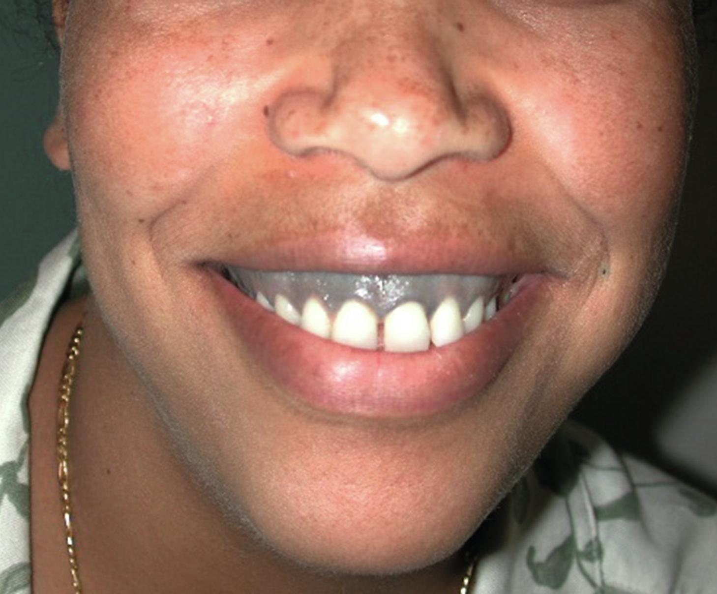 Fig. 63.1, Increased pigmentation of the gingiva in an African American.