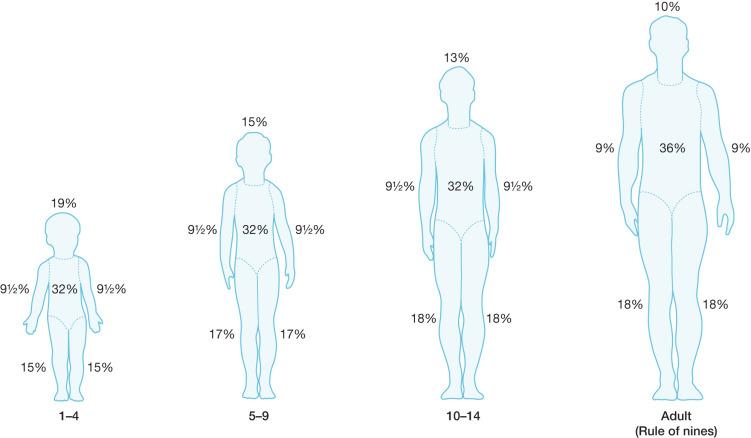 Fig. 35.5, The “rule of nines” altered for the anthropomorphic differences of infancy and childhood.