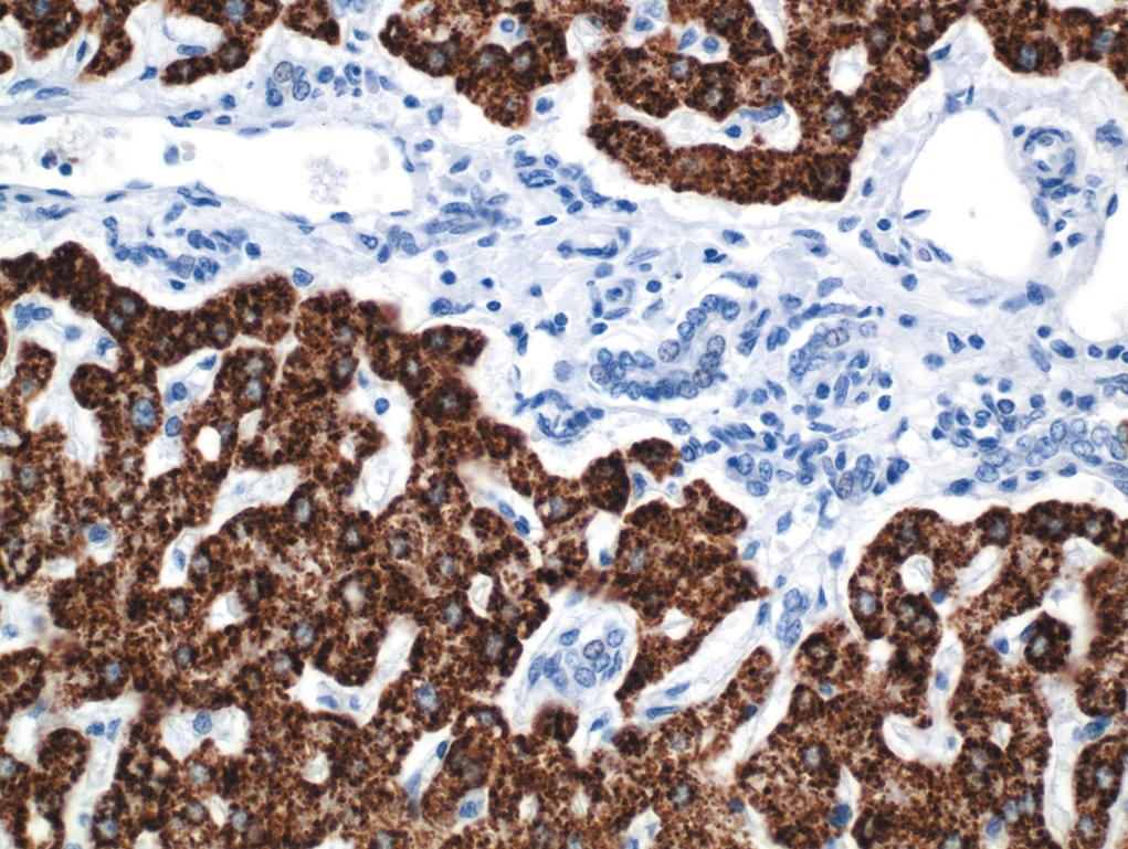 Figure 1.12, Immunohistochemistry for HepPar-1 highlighting strong cytoplasmic staining of normal hepatic parenchyma.