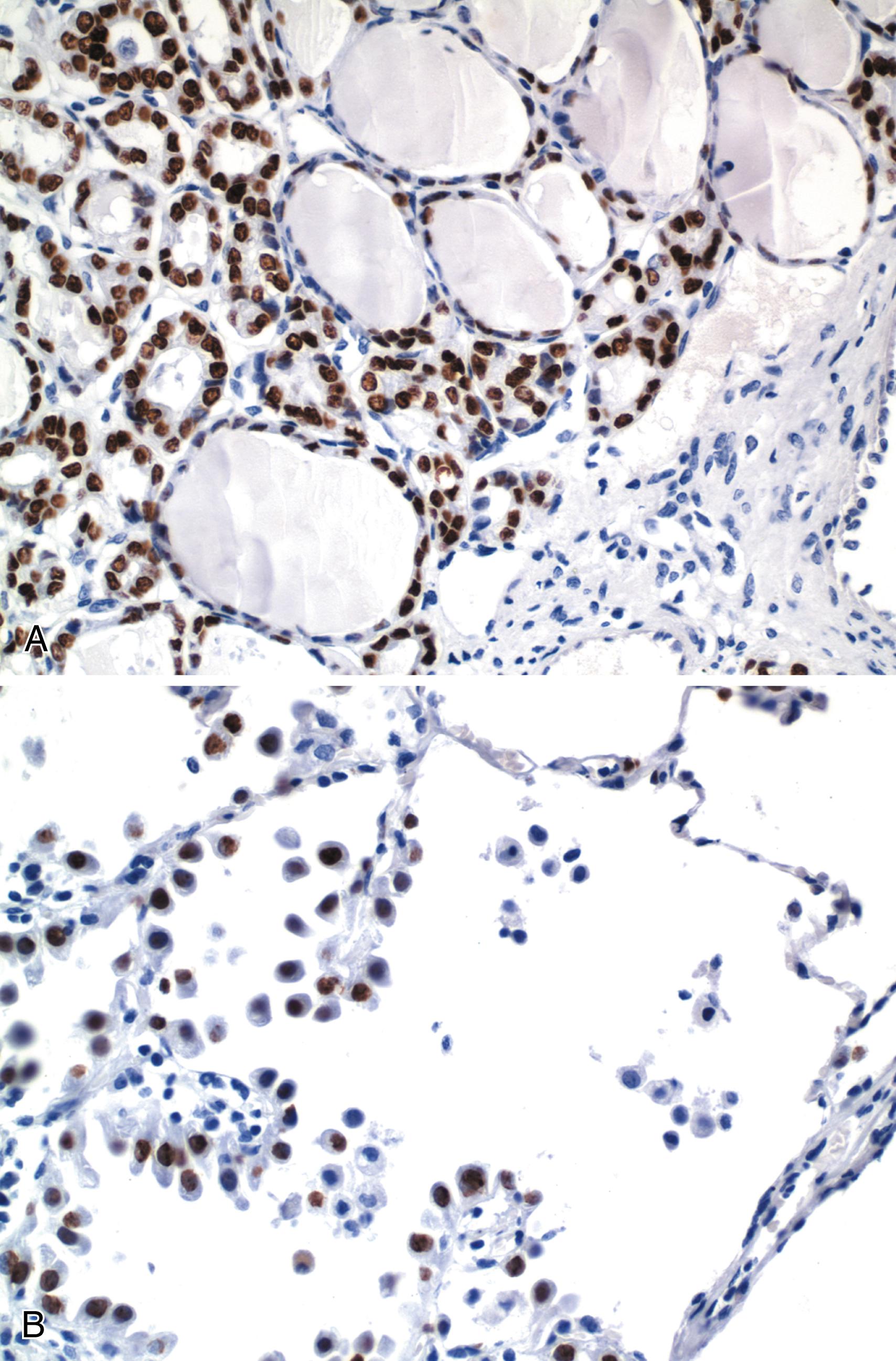 Figure 1.13, Immunohistochemistry for TTF-1.