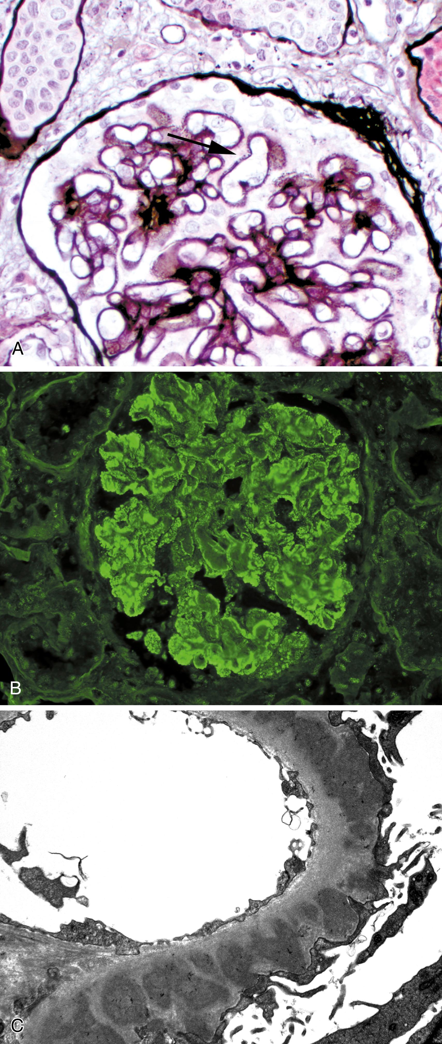 Figure 1.3, Membranous glomerulopathy.