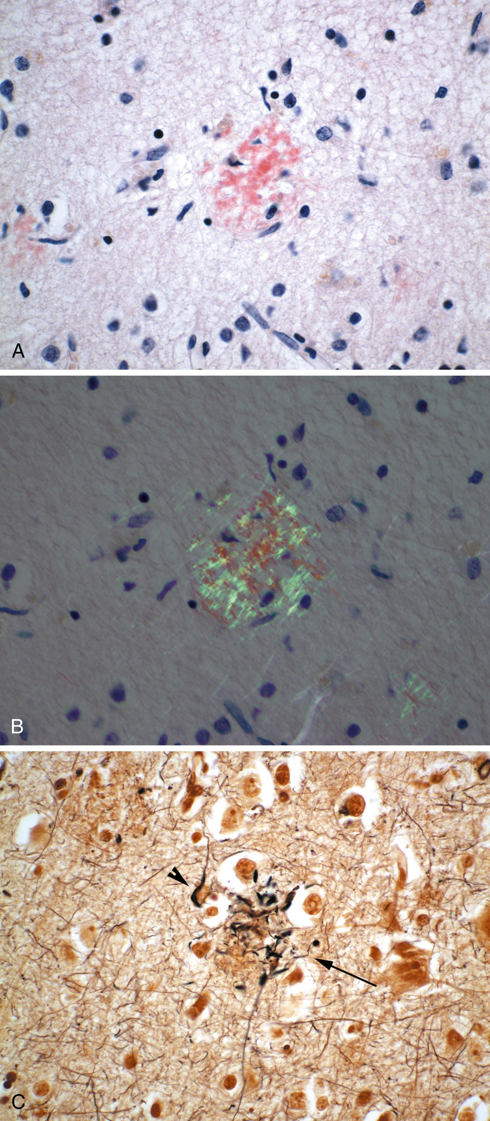 Figure 1.4, Alzheimer disease.