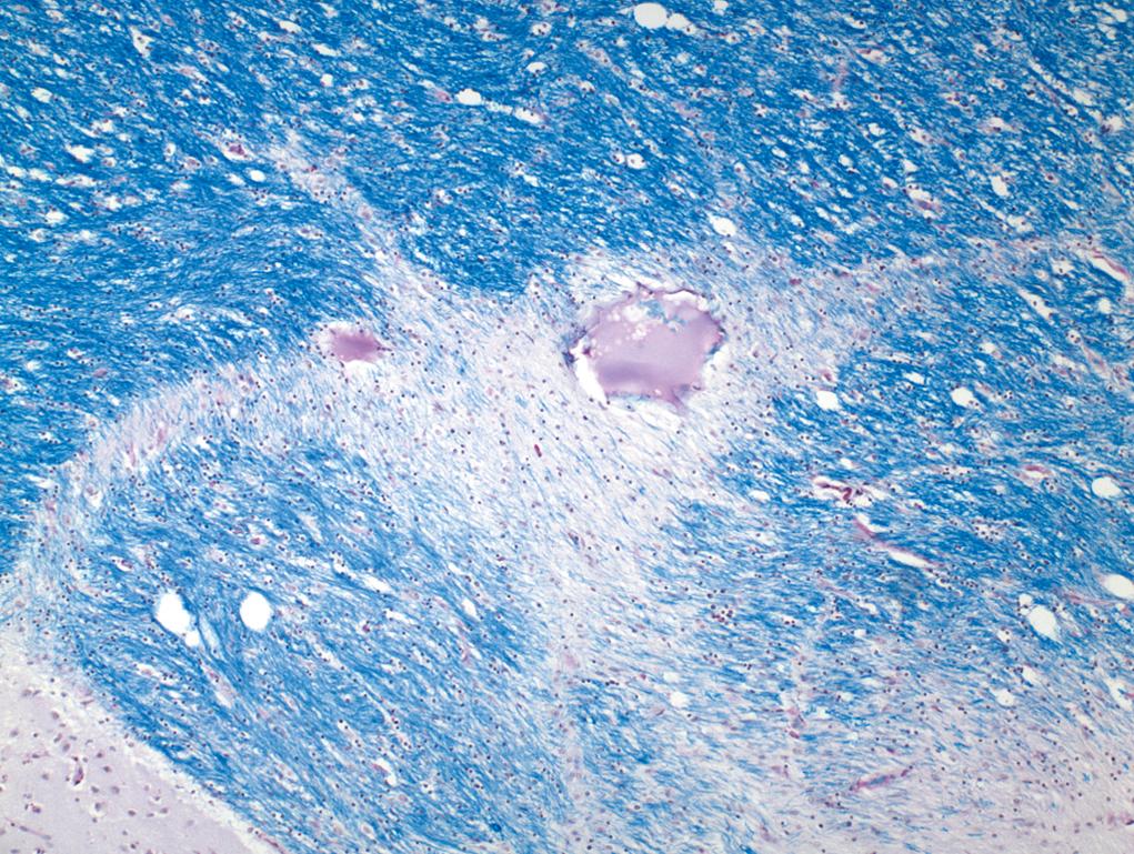 Figure 1.5, Luxol fast blue stain.