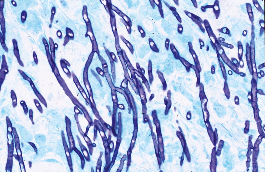 Figure 1.6, Aspergillus organisms in the lung stained by Grocott methenamine silver stain.