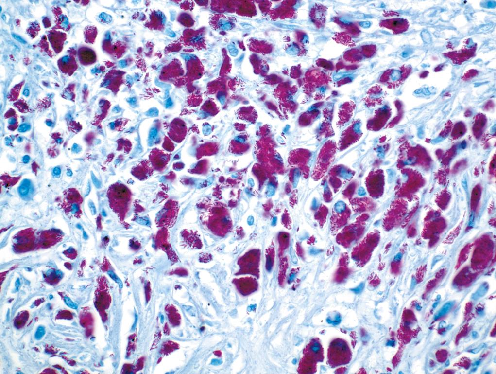 Figure 1.7, Ziehl-Neelsen stain for acid-fast bacilli.