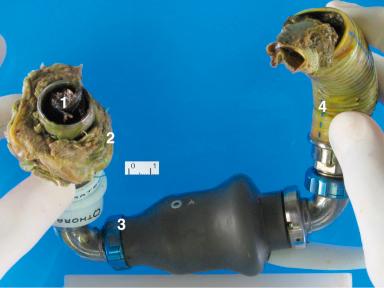 Figure 6-3, Left ventricular assist devices (Thoratec HeartMate2 shown) should have examination of: 1, inlet port for thrombus, infection, and position relative to interventricular septum; 2, tissue anastomosis (apical myocardium) for infection; 3, in-device lumen for thrombus (all knurled connections come apart without special tools); and 4, aortic outlet port for thrombus and infection.