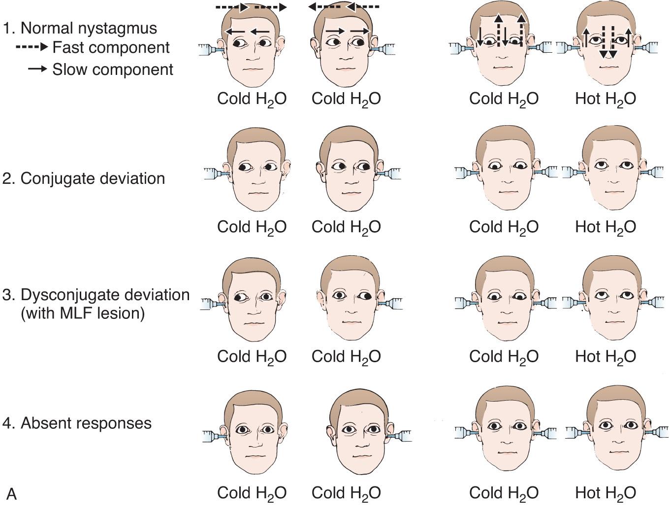 Figure 61.2, A, The four types of caloric responses seen with unilateral and bilateral irrigation. 1, Normal nystagmus. 2, Conjugate deviation. 3, Dysconjugate deviation. 4, Absent caloric responses. B, Oculocephalic and oculovestibular testing in patients with selected clinical conditions.