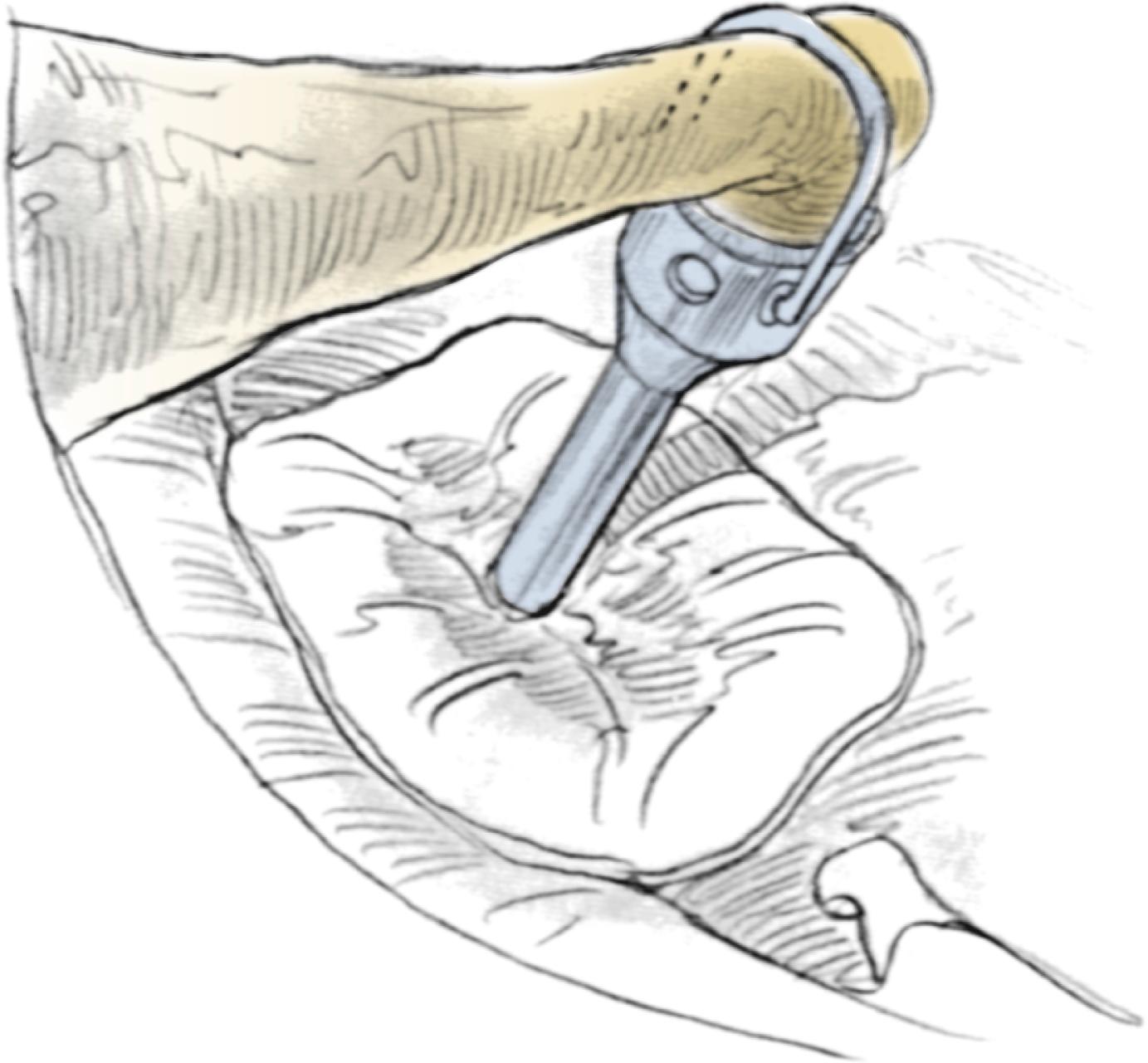 Fig. 24.2, Routine stapedectomy.