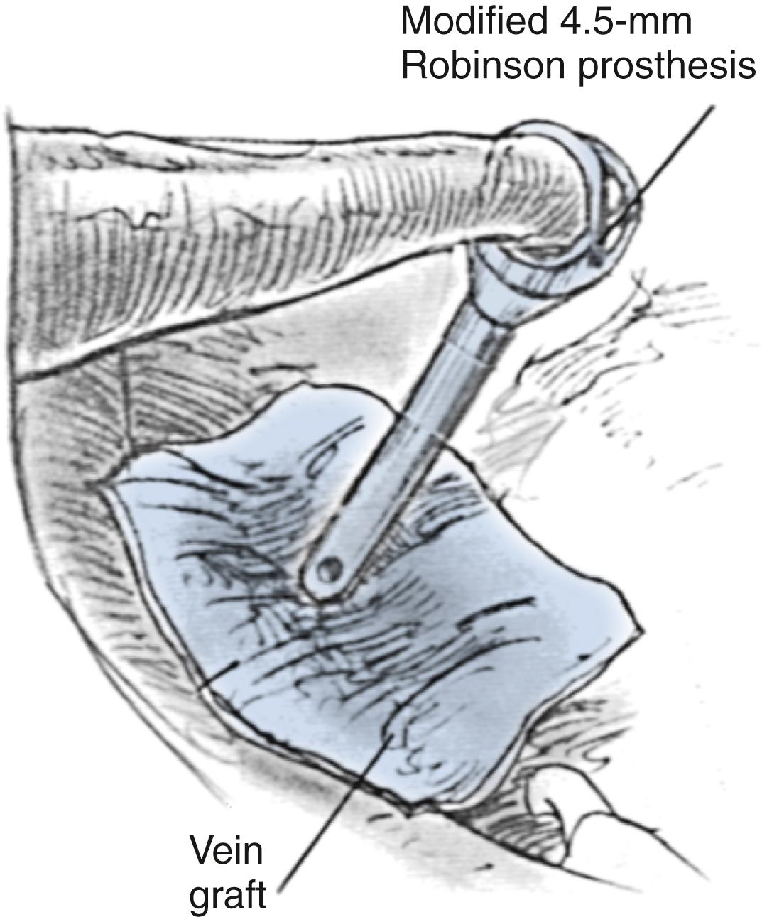 Fig. 24.4, Modified 4.5-mm Robinson prosthesis in place on vein graft covering oval window.