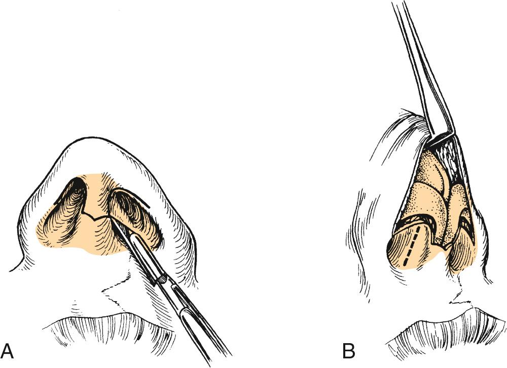 Fig. 32.1, The external (open) approach.