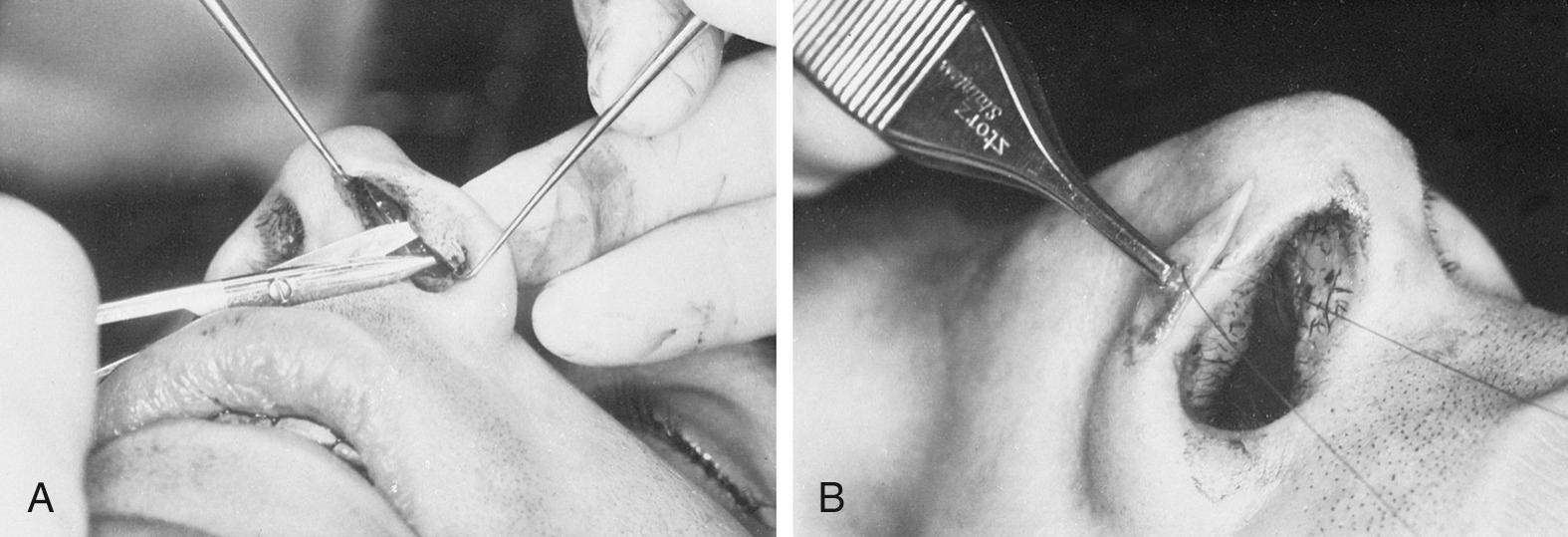 Fig. 32.13, Retrograde alar margin implant.