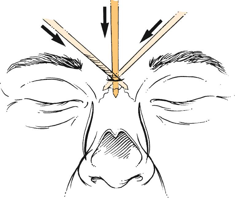 Fig. 32.14, The nasofrontal angle is reduced by placing a 2-mm osteotome through a stab incision and creating a deeper angulation by joining the two lateral osteotome cuts at right angles.