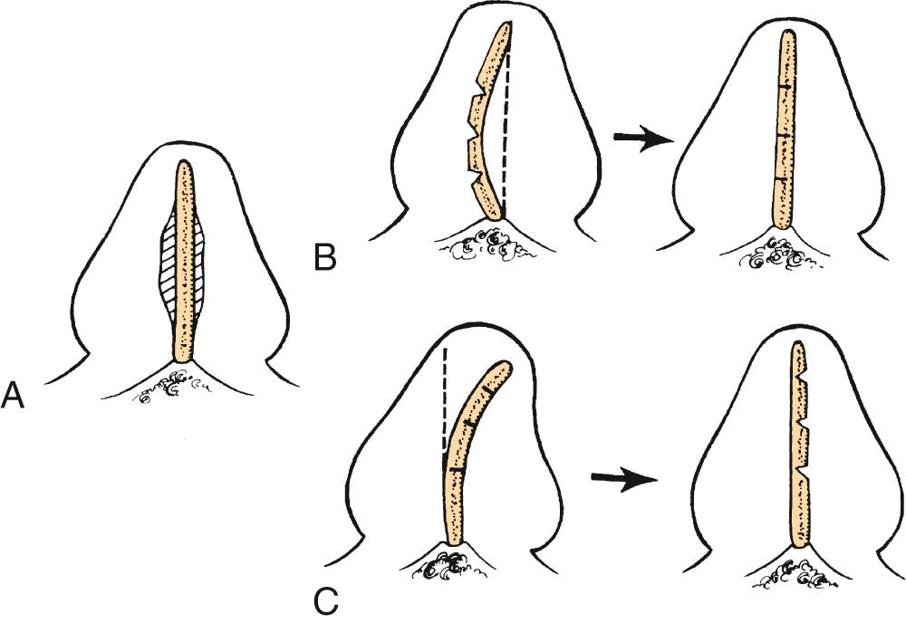 Fig. 32.2, Correcting septal curvature.