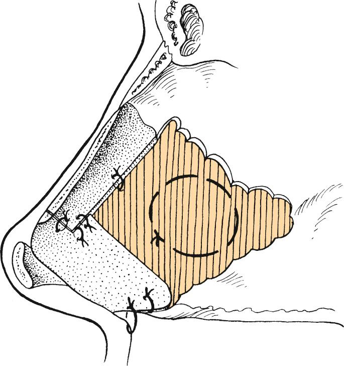 Fig. 32.4, Coaptation sutures.