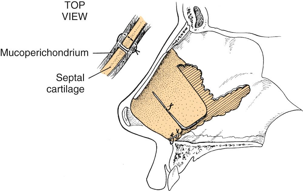 Fig. 32.5, Repositioning and suturing of the caudal septum.