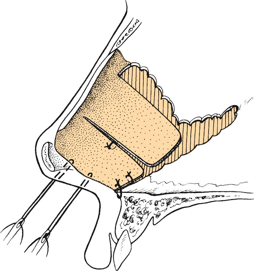 Fig. 32.6, Stabilization of the caudal septum with draw sutures through the center of the columella reestablishes the septocolumellar relationship. At the end of the procedure, the draw sutures may be removed or they may be tied loosely against the columellar skin.