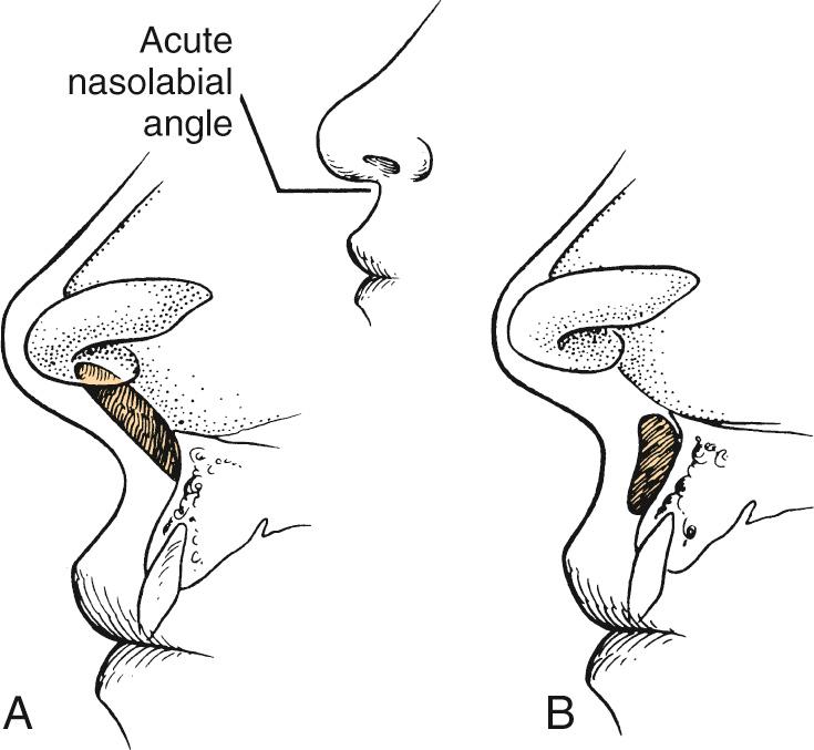 Fig. 32.8, Correction of an acute septolabial angle.