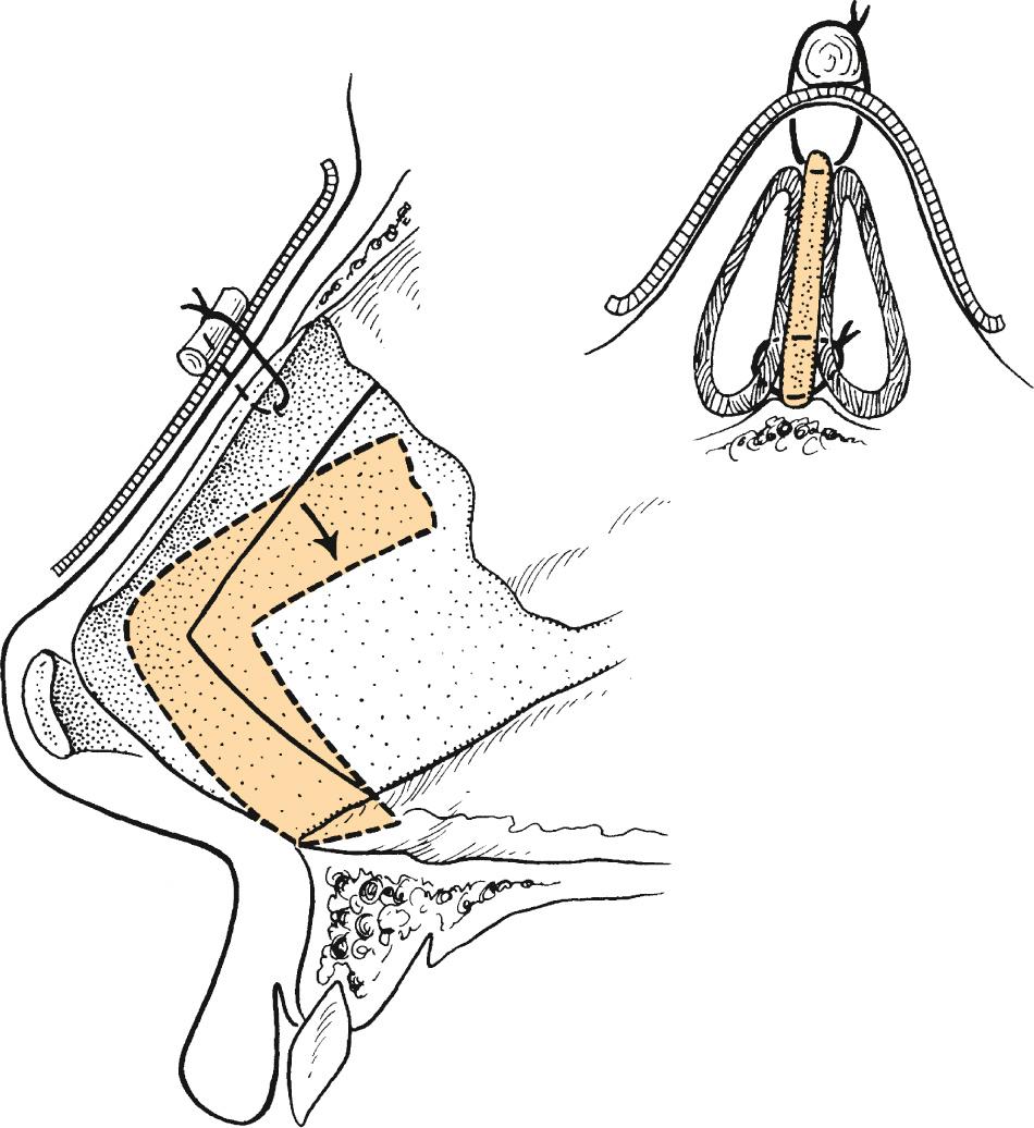 Fig. 32.10, Dorsal draw suture.