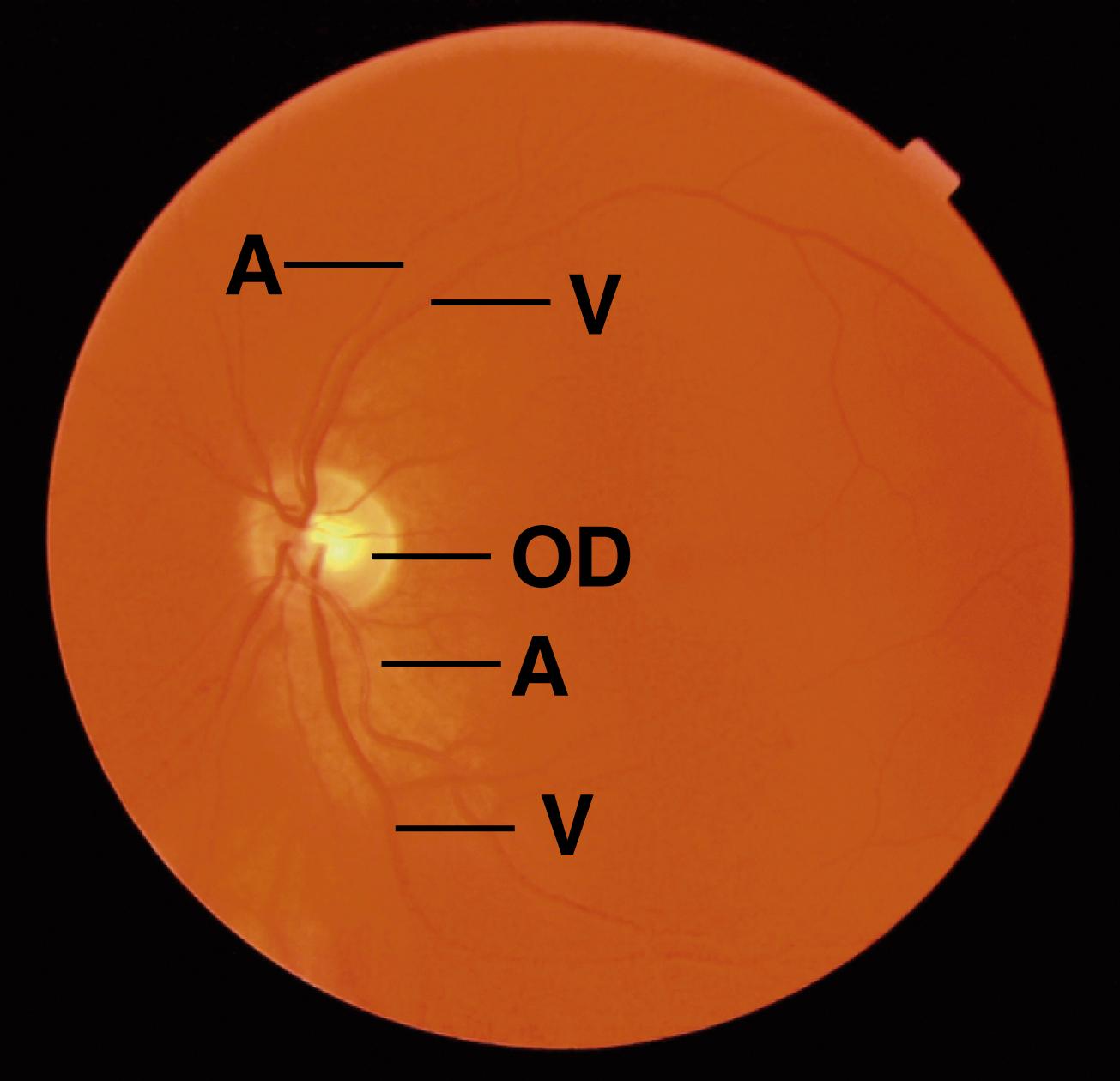 Fig. 22.13, This fundus photograph of the retina displays the optic disc (OD) and arteries (A) and veins (V) of the retina. Note that the veins are wider and darker than the arteries.