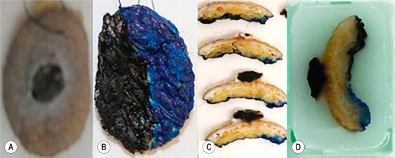 Fig. 2.1, Gross representation of pyogenic granuloma ( A ), with two-color painting of the inferior surface ( B ). 2-mm–thick gross sections demonstrating the black and blue painting at put-through ( C ) and in paraffin blocks ( D ).