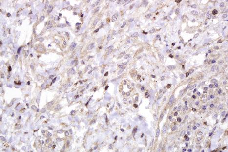 Fig. 2.11, Technical artifact: suboptimal antibody concentration of CD3 antibody resulting in background staining.